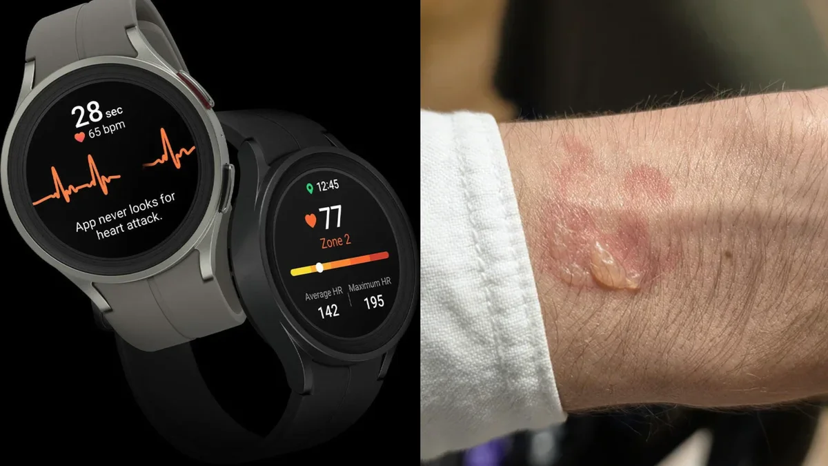 Usuários relatam irritação na pele e aquecimento em modelos do Galaxy Watch
